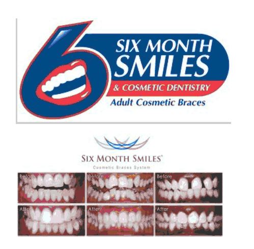 Sixmonth Smile